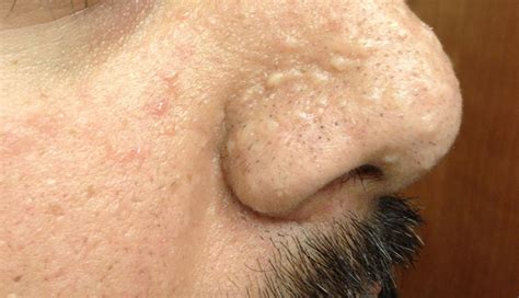 sebaceous hyperplasia nose